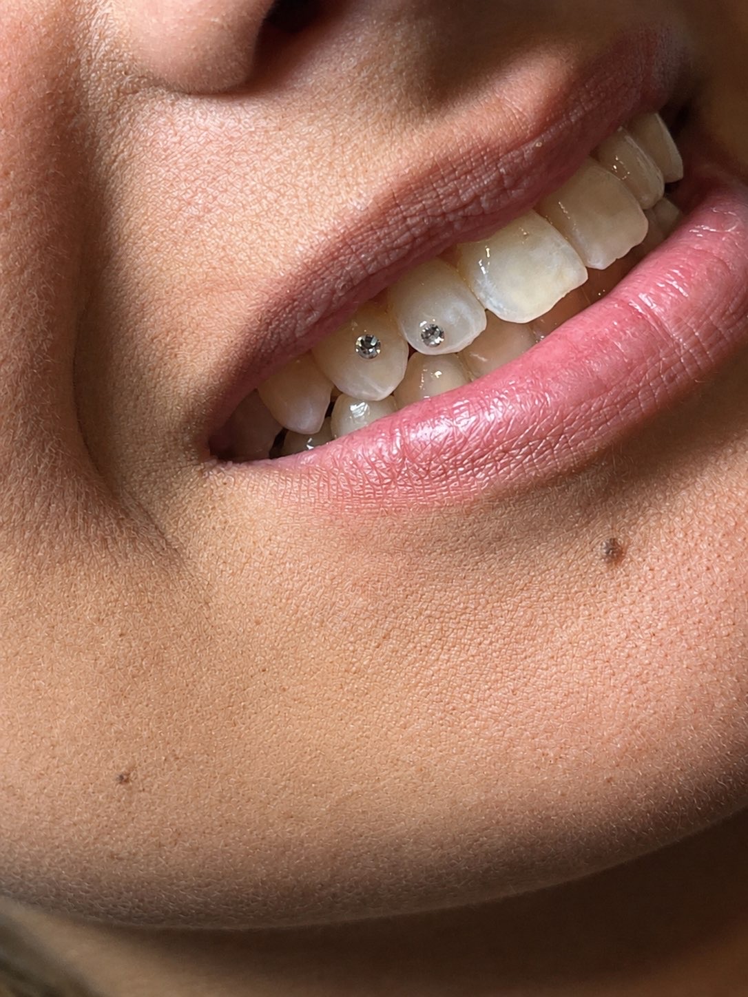 Toothgems op de tanden